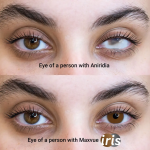IRIS/Prosthetic Soft Contact Lens